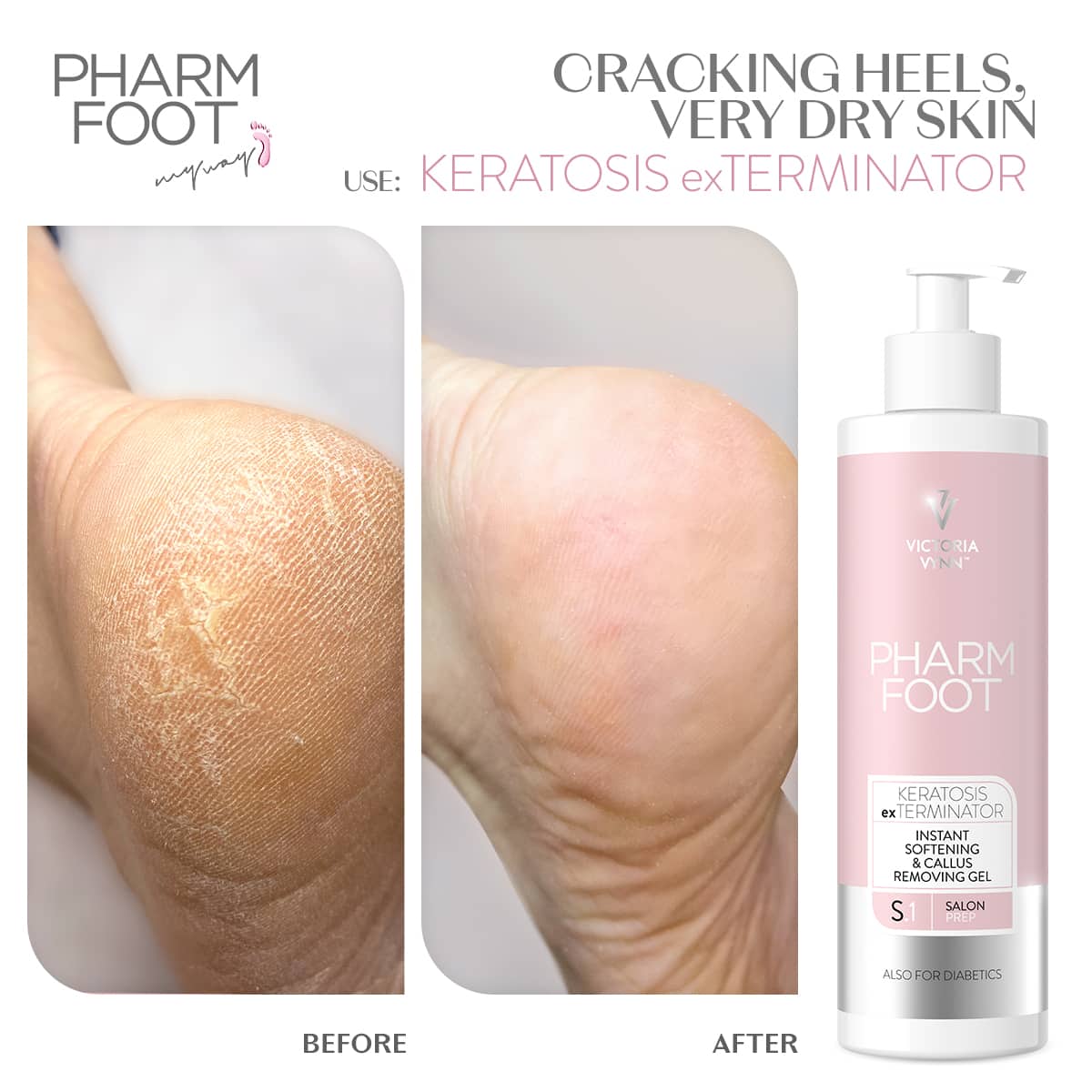 ג'ל להסרת קאלוס ויבלות - Pharm Foot | 300 ml | KERATOSIS exTERMINATOR photo number 1