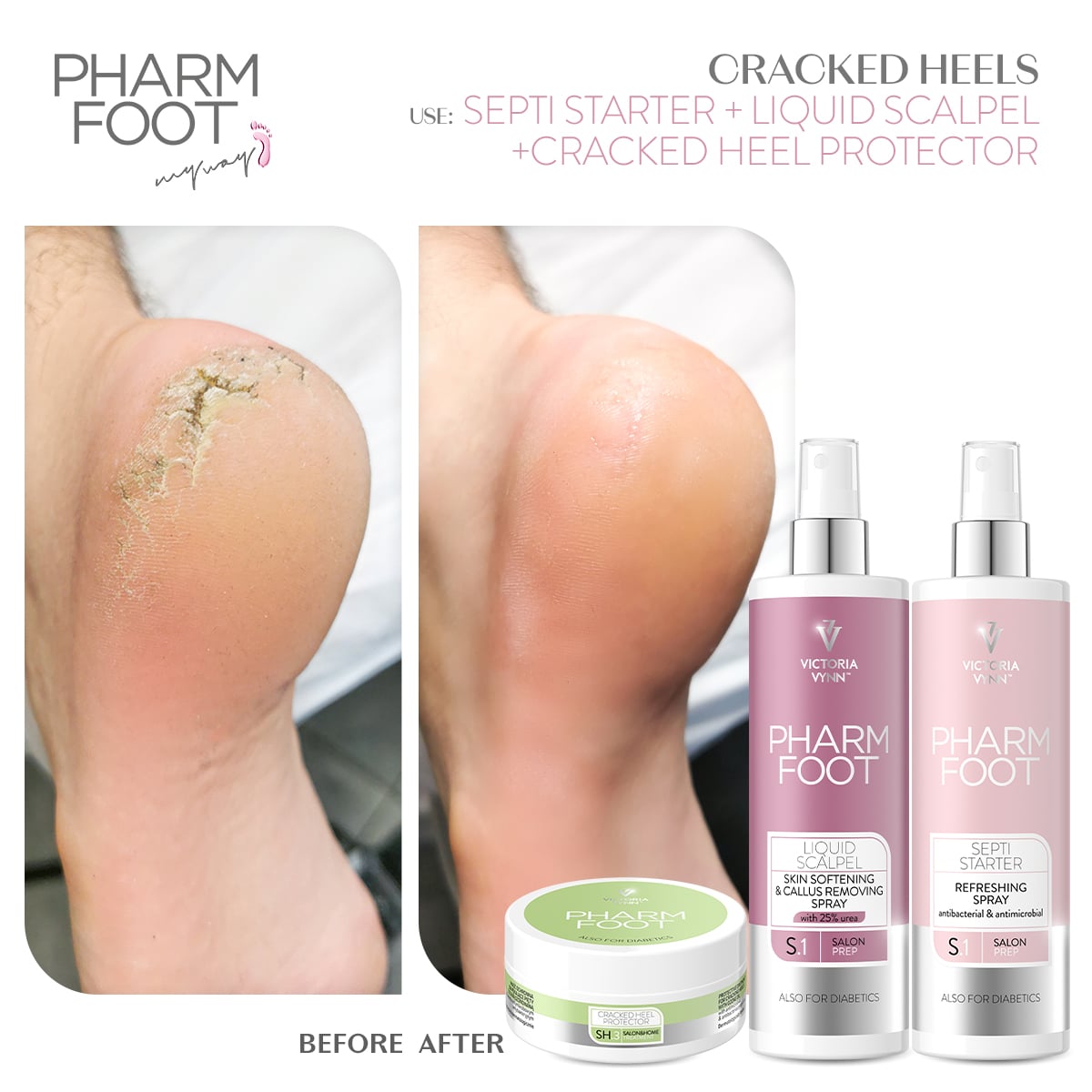 ג'ל להסרת קאלוס ויבלות - Pharm Foot | 300 ml | KERATOSIS exTERMINATOR photo number 1