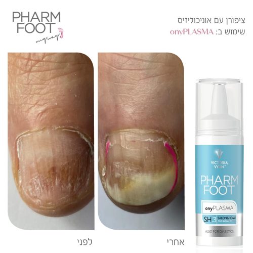 נוזל קולוסטרום לשיקום הציפורן וטיפול באוניכוליזיס - Pharm Foot | 15 ml | onyPLASMA נוזל קולוסטרום לשיקום הציפורן וטיפול באוניכוליזיס - Pharm Foot | 15 ml | onyPLASMA